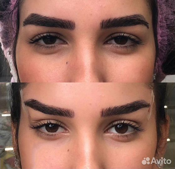 Красивый лифтинг бровей (нити, ботокс)