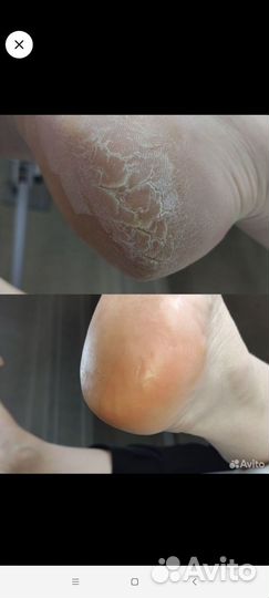 Возрастной педикюр 60+