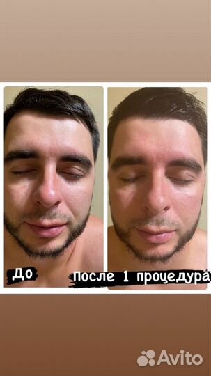 Антицеллюлитный массаж