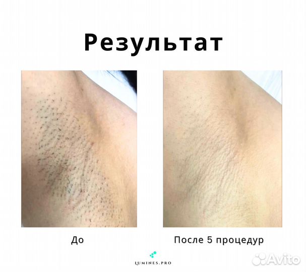 Аппарат для эпиляции Лю'Минес Max’One 1200 Вт