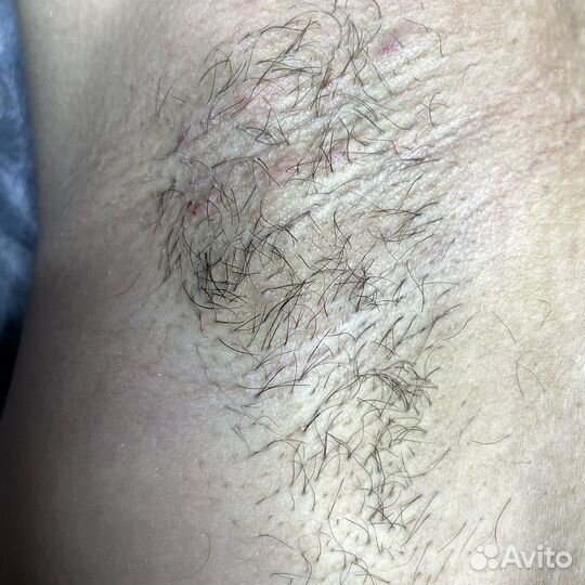 Электроэпиляция