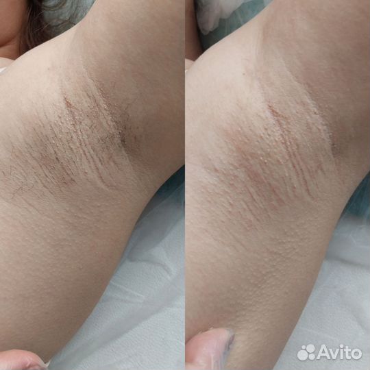 Шугаринг /Ваксинг