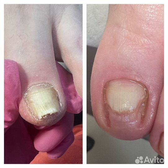 Подолог педикюр