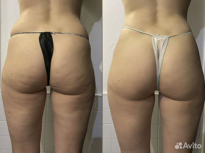 Антицеллюлитный массаж / коррекция фигуры