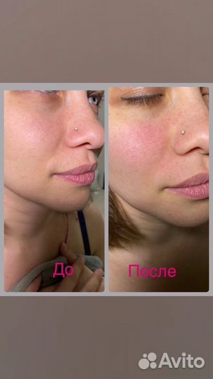 Буккальный массаж лица