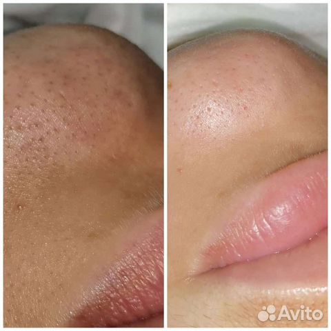 Чистка лица