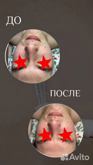 Пилинг лица фруктовыми кислотами