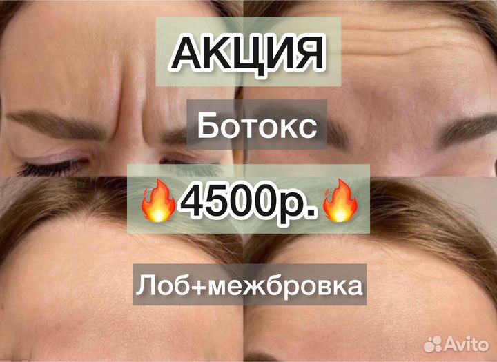 Ботокс, косметолог