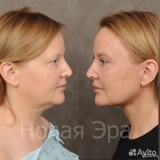 Ультра омоложение /подтяжка лица/ Минус 15 лет за