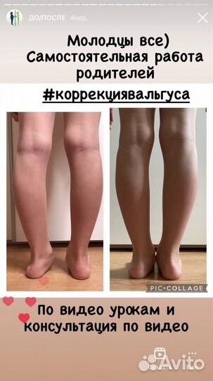 Коррекция вальгуса и осанки детям и взрослым