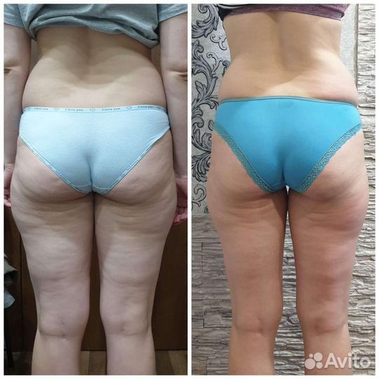 Коррекция фигуры/ скульптурный массаж