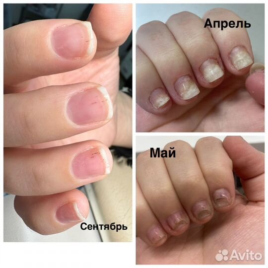 Подолог, вросший ноготь, грибок, зачистка