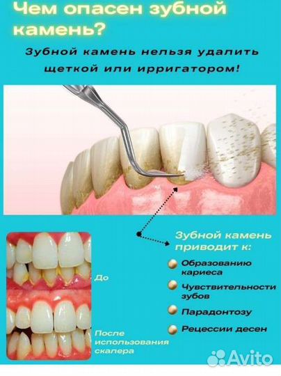 Ультразвуковой скалер