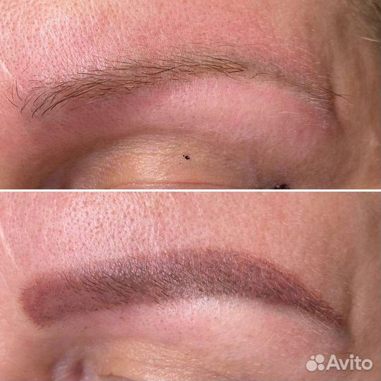 Удаление некачественного татуажа ремувером