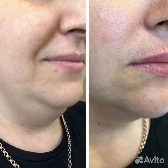 Липолитики в лицо и тело
