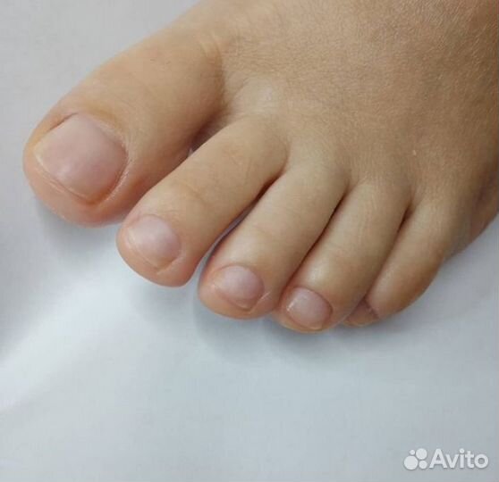 Педикюр, сложные стопы, титановая нить, скоба 3то