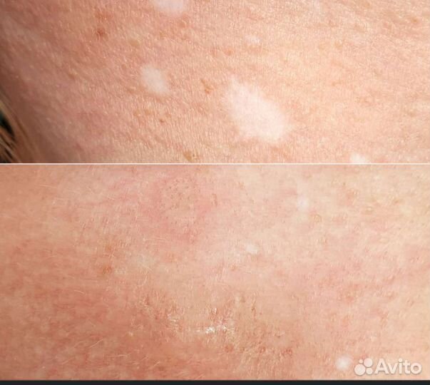 Камуфляж шрамов,растяжек