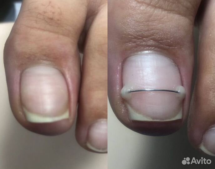 Подолог Медицинский педикюр Выезд на дом