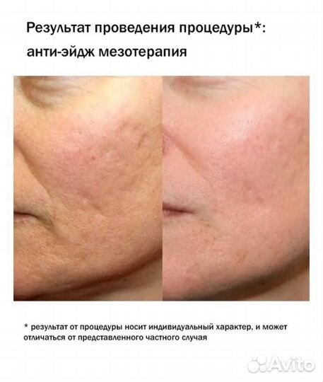 Дермапен ultima-E30-W, микронидлинг, мезотерапия