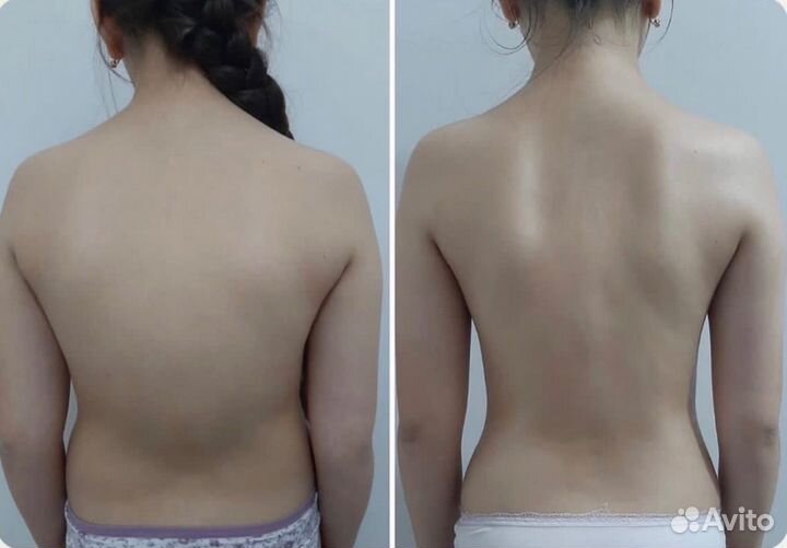 Массаж от сколиоза и сутулости