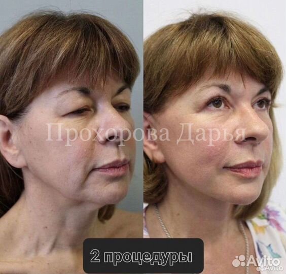 Smas-лифтинг модель