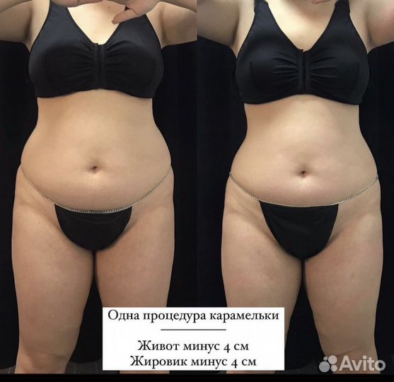 Карамельная липосакция
