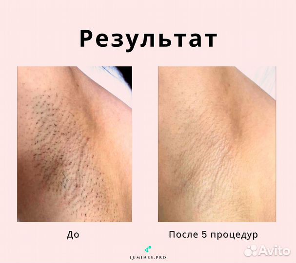 Диодный лазер Lumines Max’One 1200в