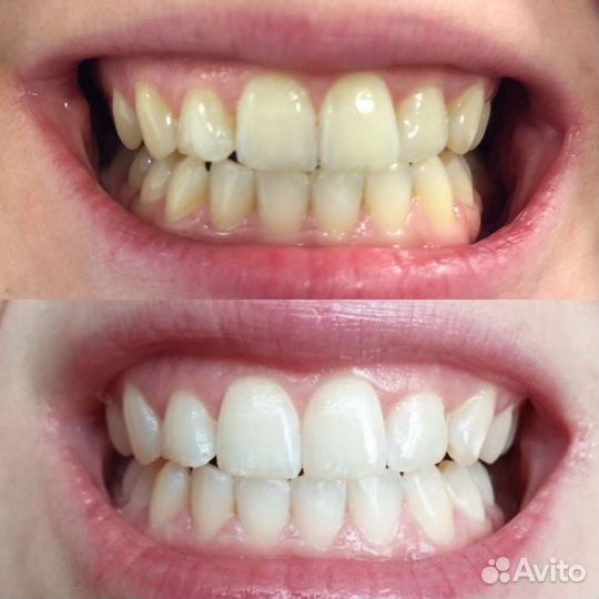 Отбеливание зубов