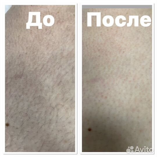 Лазерная эпиляция Элос