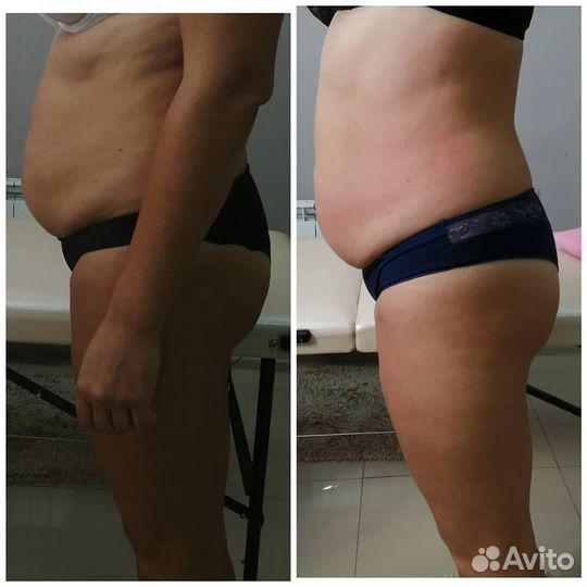 LPG массаж плюс костюм дарю