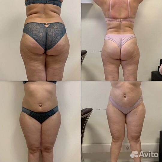 LPG, Эндосфера Кавитация депиляция массаж лица