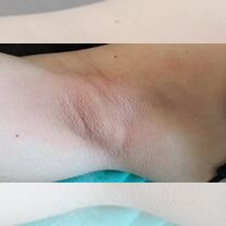Депиляция Шугаринг, Красноярск
