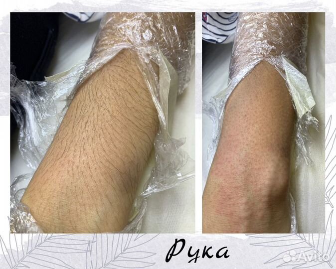 Электроэпиляция: бёдра