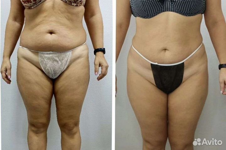 Антицеллюлитный массаж