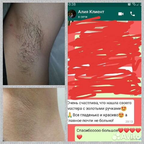 Депиляция