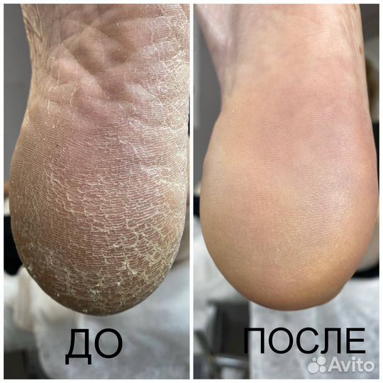 Педикюр подолог