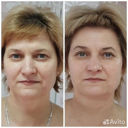Лифтинг лица. Витапластика/Омоложение