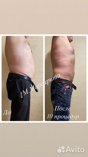 Антицеллюлитный массаж