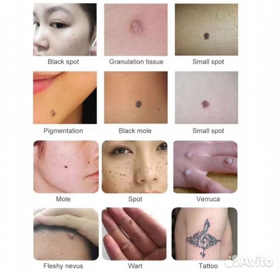 Аппарат для удаления татуировок родинок и папиллом