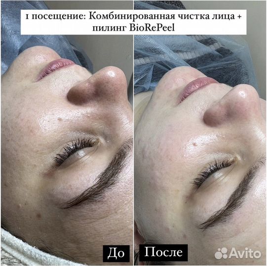 Чистка лица + пилинг в подарок