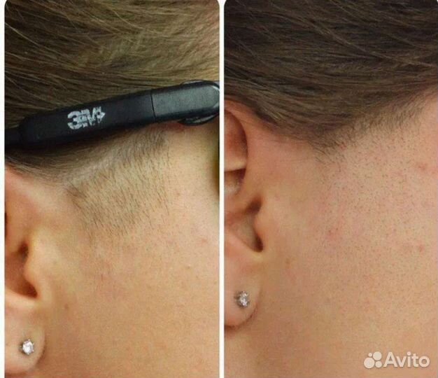 Лазерная эпиляция/фотоэпиляция/удаление тату