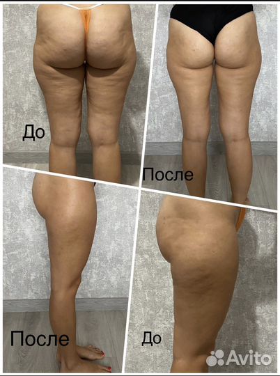 Массаж антицеллюлитный,лимфодренажный,буккальный