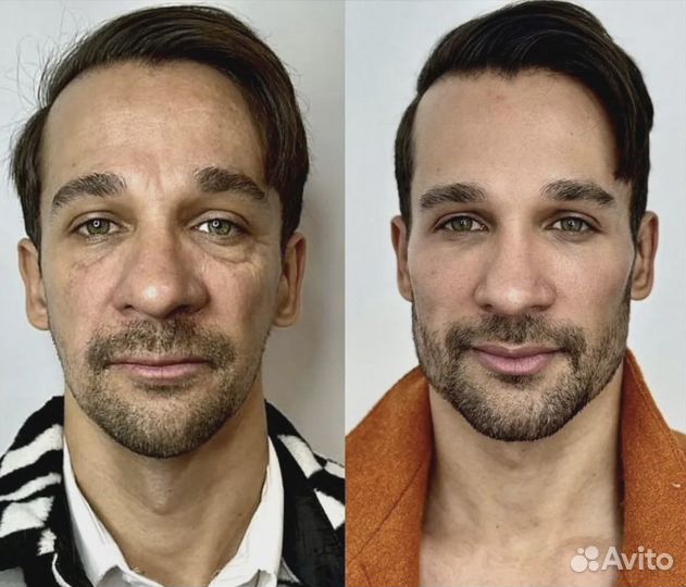 Подтяжка лица за 1 процедуру. СМАС лифтинг