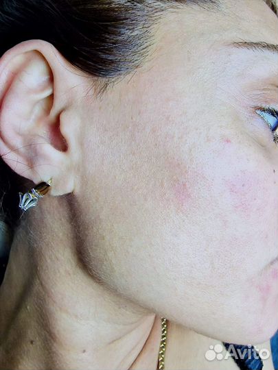 Мастер диодный эпиляции