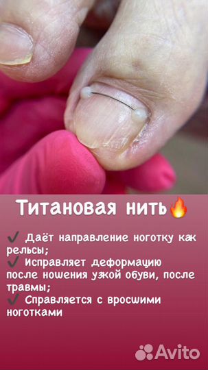 Вросшие ногти, бородавки, титановая нить, педикюр