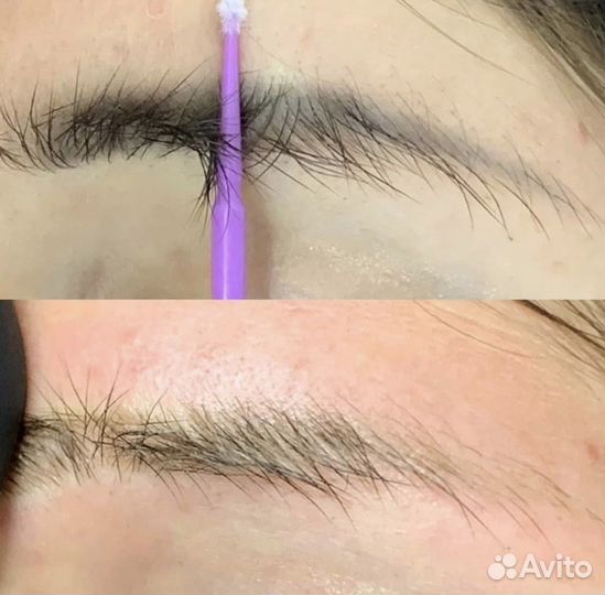 Удаление татуажа лазером