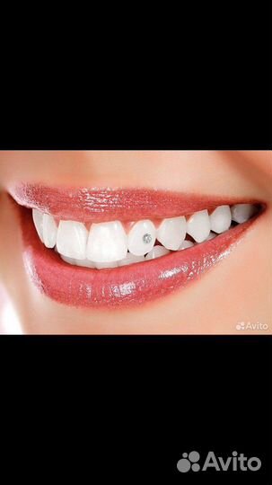 Установка скайсов (кристаллов) на зубы