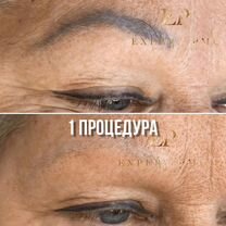 Удаление татуажа и тату лазером PicoSure пикошур, Москва