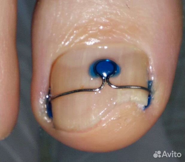 Обработка вросшего ногтя