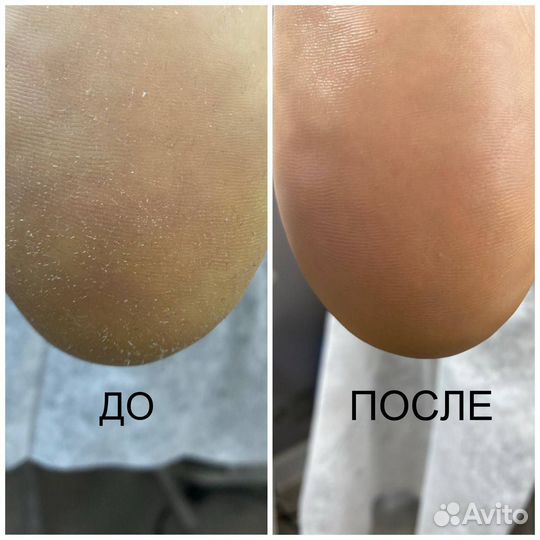 Педикюр подолог